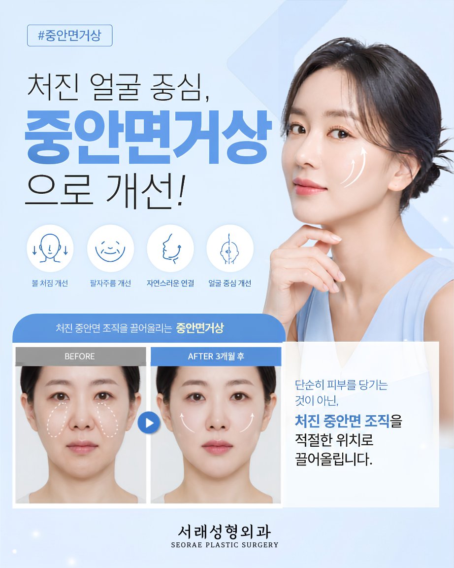 중안면거상, 어떤 볼 처짐에 맞을까 사진 3