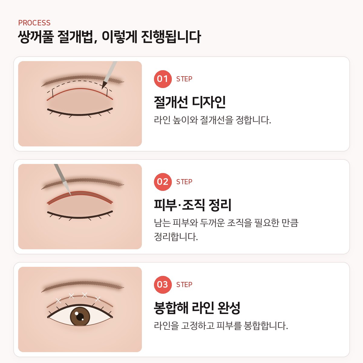 쌍꺼풀 절개법, 두꺼운 눈꺼풀에 무엇을 해 줄까